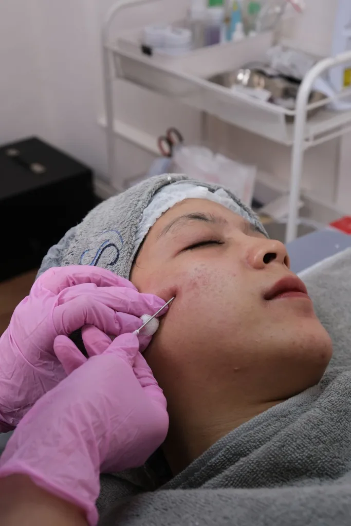 A practitioner in gloves holding a fine needle against a client's cheek during a skin treatment session, the client resting with her eyes closed