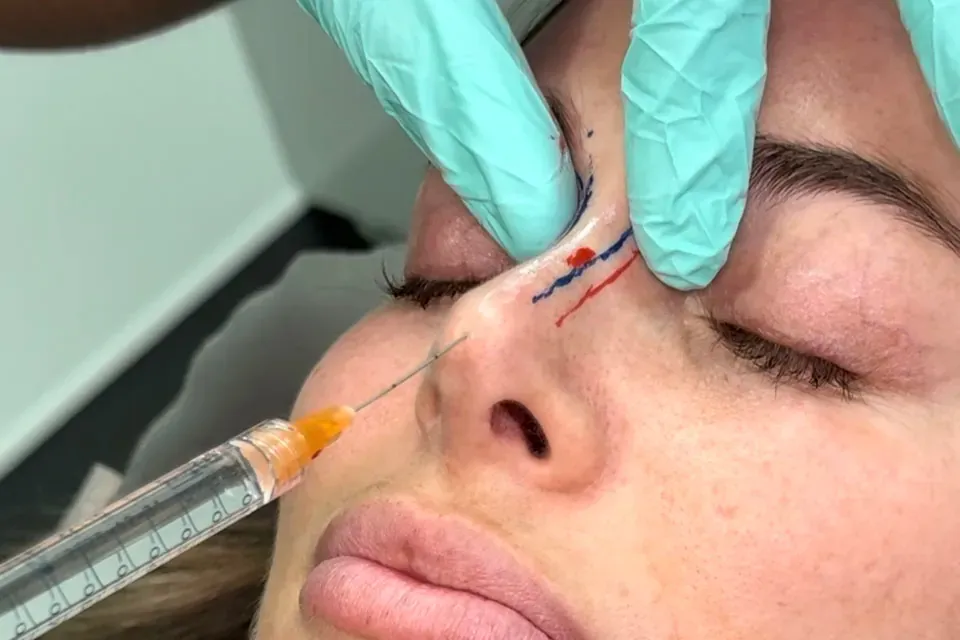 Nose-Filler