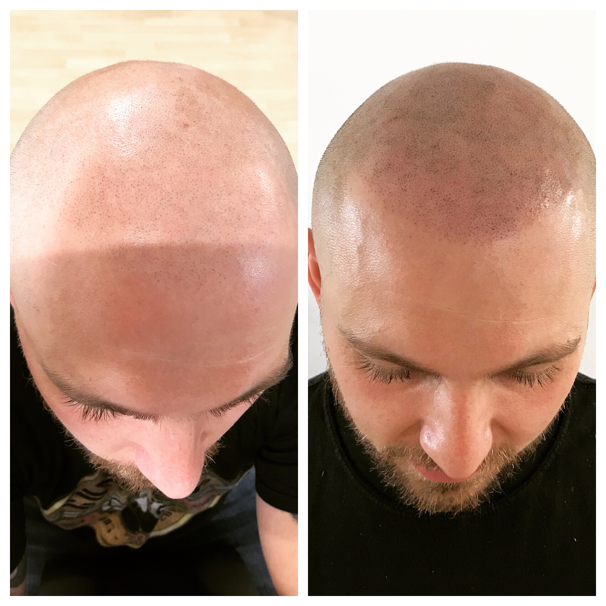 Scalp micropigmentation treatment