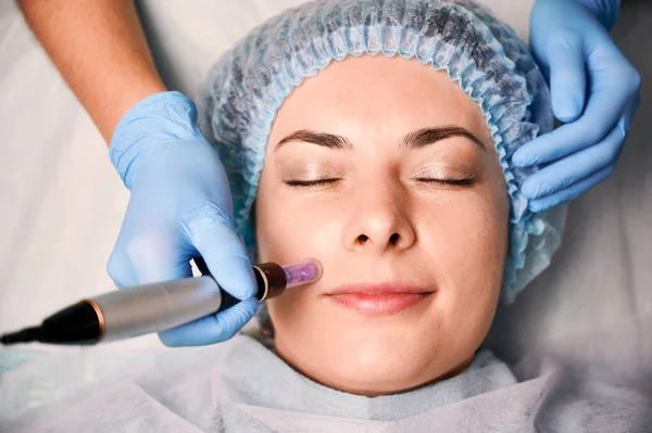 Microneedling treatment