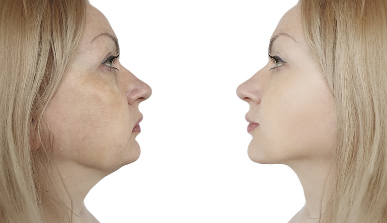 Endolift treatment